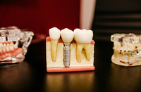 Implantologie in der Zahnarztpraxis Ochinko