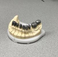Zahnersazt in der Zahnarztpraxis Ochinko
