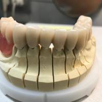 Zahnersazt in der Zahnarztpraxis Ochinko