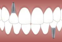 Implantologie - Zahnarztpraxis Ochinko